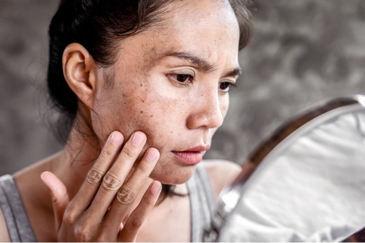 ¿Cómo Disminuir Manchas en la Piel por el Sol?