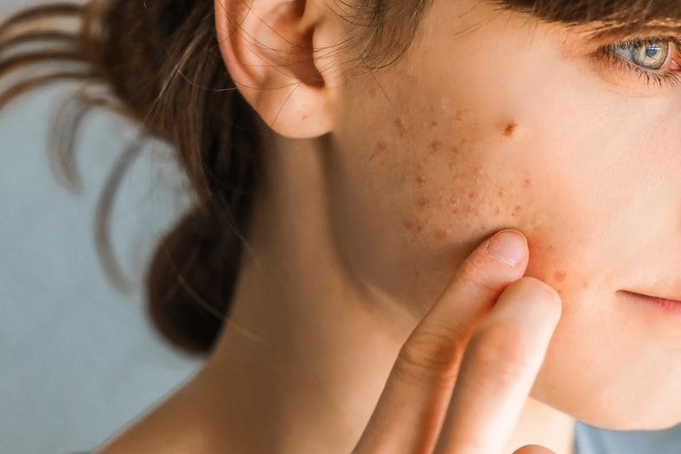 No Más Marcas por Acné Gracias a Cicavent